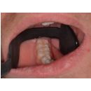 Smile Line Retraktor na dentálnu fotografiu - spodné zuby